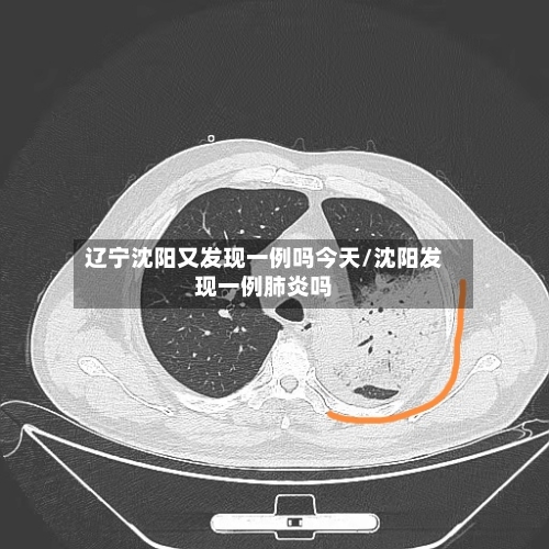 辽宁沈阳又发现一例吗今天/沈阳发现一例肺炎吗-第3张图片
